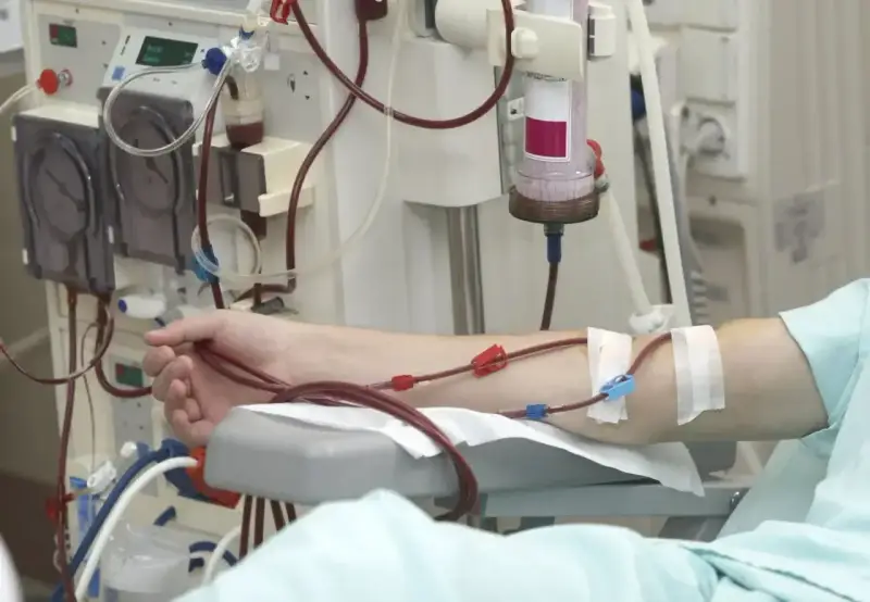 Ramię pacjenta podłączone do aparatury do dializy. Rozważamy dializa otrzewnowa wady i zalety.