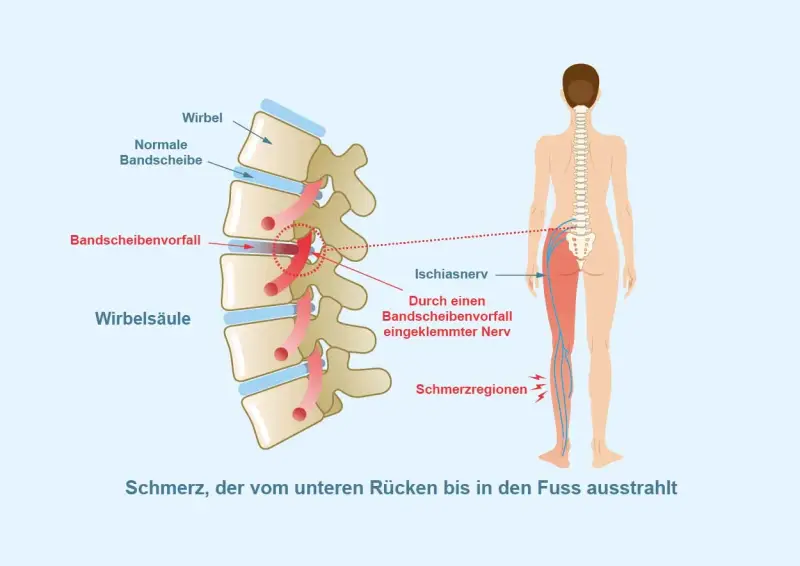 Illustration zeigt Bandscheibenvorfall, der Ischiasnerv reizt. Schmerz strahlt vom Rücken ins Bein aus. Mögliche Linderung durch Ischias Medikamente.