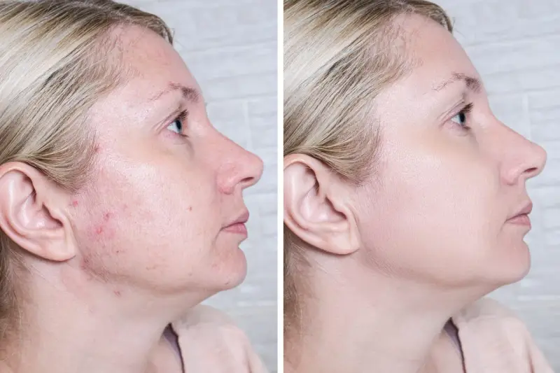 Przed i po: skóra z niedoskonałościami i zaczerwienieniami po zastosowaniu Acne Derm. Efekty widoczne!