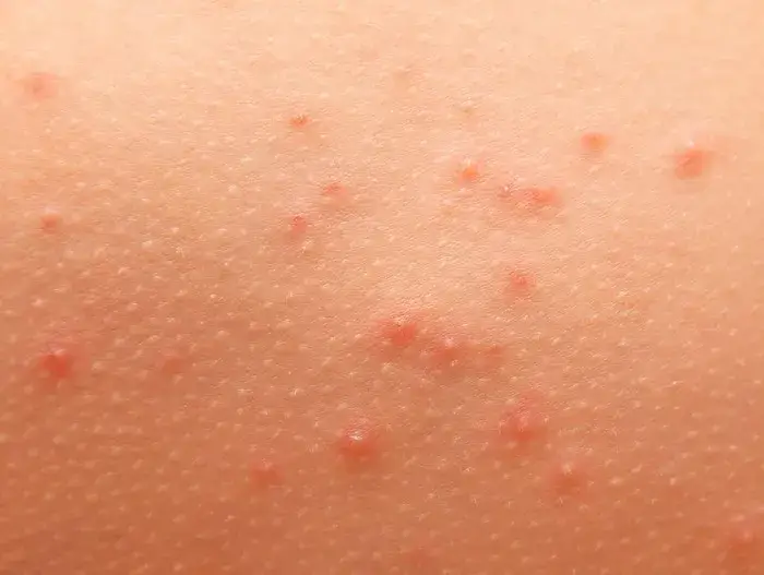 Alergia pokarmowa objawy na skórze – rozpoznaj niebezpieczne symptomy