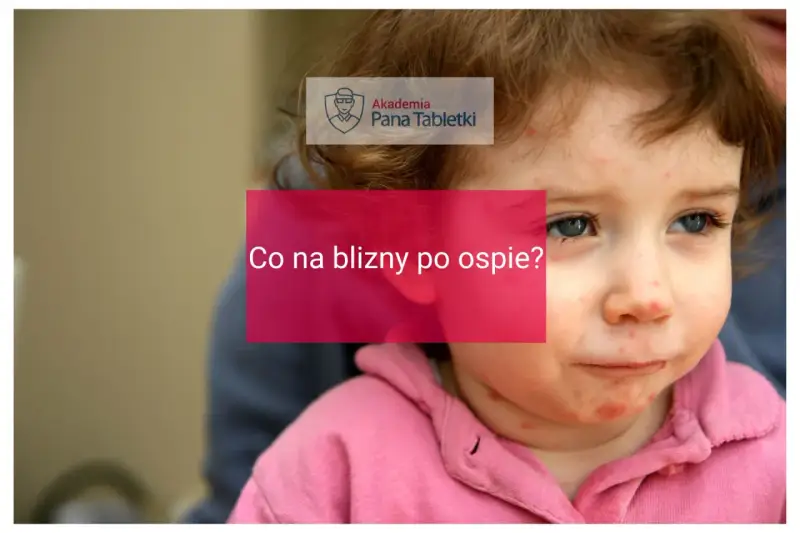 Twarz dziecka z widocznymi śladami po ospie. Napis "Co na blizny po ospie?" sugeruje poszukiwanie rozwiązań.