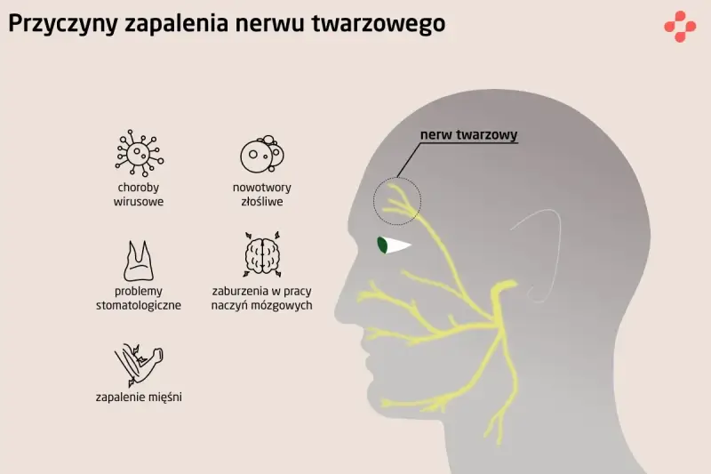 Ilustracja przedstawia przyczyny zapalenia nerwu twarzowego, w tym neuralgia nerwu trójdzielnego, choroby wirusowe, nowotwory, problemy stomatologiczne, zaburzenia naczyń mózgowych i zapalenie mięśni.