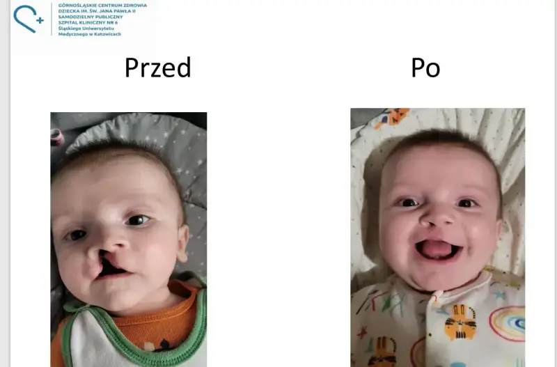 Uśmiechnięte dziecko po korekcie rozszczepu wargi. Wcześniej widoczna była zajęcza warga.