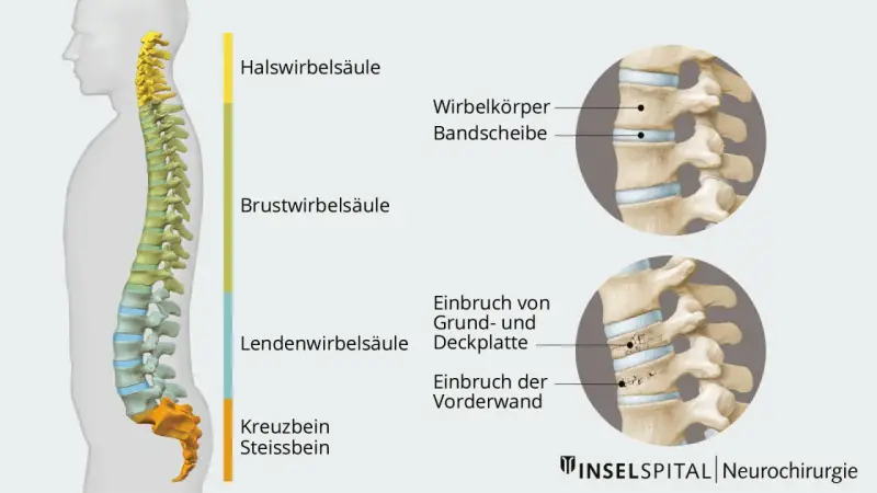 Illustration der Wirbelsäule mit Darstellung eines Wirbelbruchs. Mögliche wirbelbruch symptome werden durch die gezeigten Frakturen verdeutlicht.