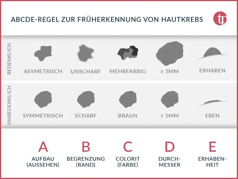 ABCDE-Regel zur Früherkennung von Hautkrebs: Asymmetrie, Begrenzung, Colorit, Durchmesser, Erhabenheit. Hilft, Hautkrebs frühzeitig zu erkennen.