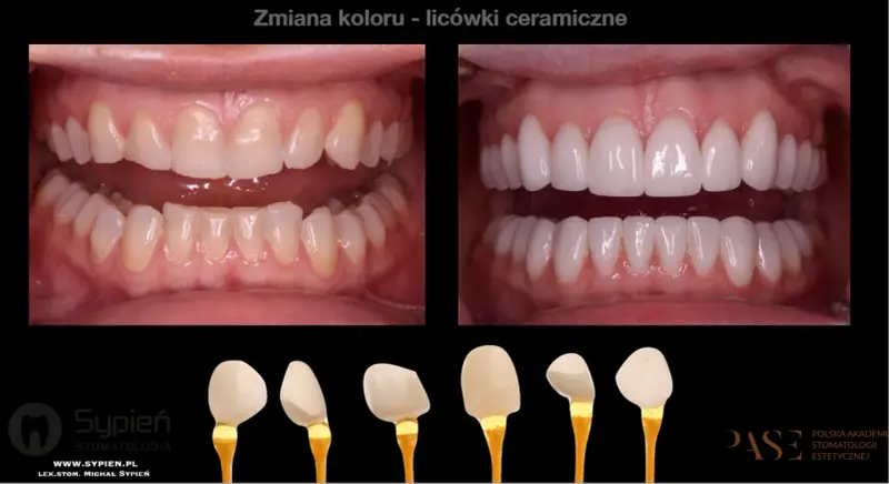 Przed i po metamorfozie zębów: od naturalnego koloru do olśniewającego, hollywoodzki uśmiech dzięki licówkom ceramicznym.
