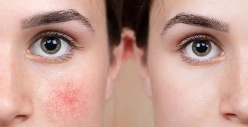 Porównanie skóry: po lewej widoczne zaczerwienienie i rumień, typowe dla skóry naczynkowej, po prawej skóra wygładzona i bez niedoskonałości.