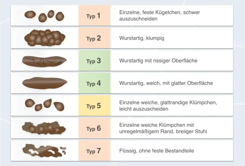 Typ 6 zeigt einzelne weiche Klümpchen mit unregelmäßigem Rand, was auf breiigen Stuhlgang hindeutet. Die Abbildung vergleicht verschiedene Stuhlformen.