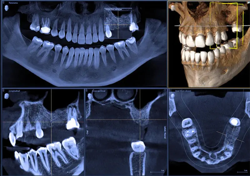 Badanie CBCT zębów: panorama, przekroje i wizualizacja 3D szczęki. Widoczne ubytki i korony.