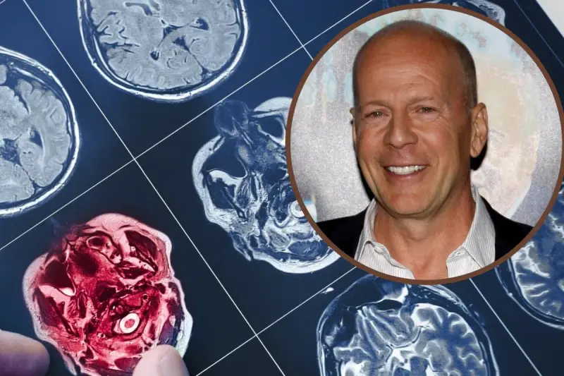 Bruce Willis choroba: obraz rezonansu magnetycznego mózgu obok uśmiechniętej twarzy aktora.