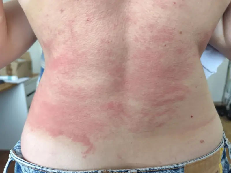 Le dos présente des rougeurs et des plaques, signe d'une réaction cutanée. Il est urgent de trouver une solution pour calmer les démangeaisons.
