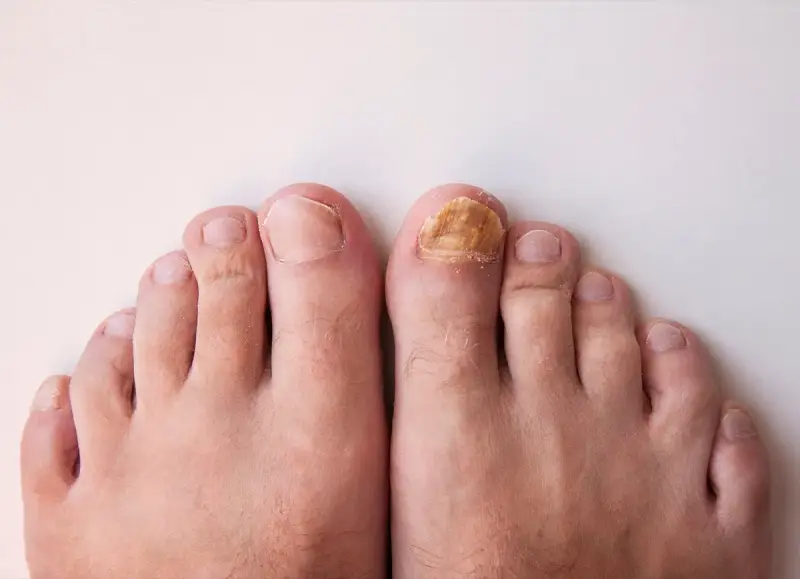 Gros plan sur des pieds, dont un ongle d'orteil atteint d'une mycose, illustrant un problème d'entretien ongles pieds.