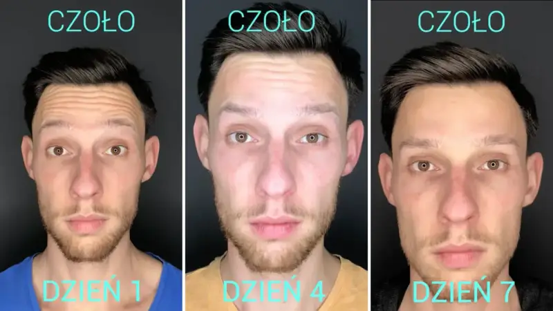 Trzy zdjęcia mężczyzny pokazujące efekt botoksu na czoło: dzień 1 (zmarszczki), dzień 4 (zmniejszone zmarszczki), dzień 7 (gładkie czoło).