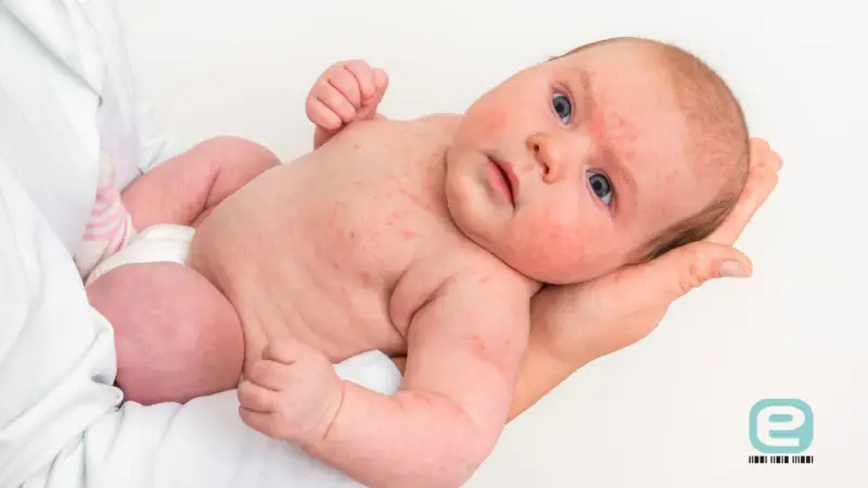 Niemowlę z widoczną wysypką alergiczną na twarzy i ciele. Czerwone plamki pokrywają skórę, wskazując na reakcję alergiczną u dziecka.