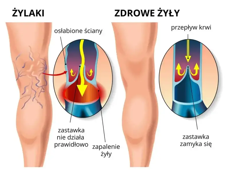 Ilustracja pokazuje nogę z żylakami i zdrową nogę. Flebolog wyjaśnia, że przy żylakach zastawki nie działają, powodując zapalenie.