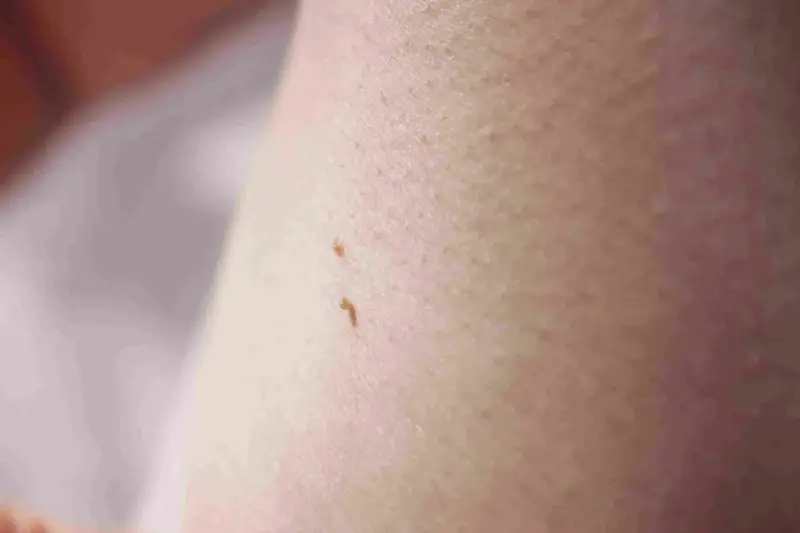 Dwa małe, brązowe znamiona na skórze, przypominające małe włókna.