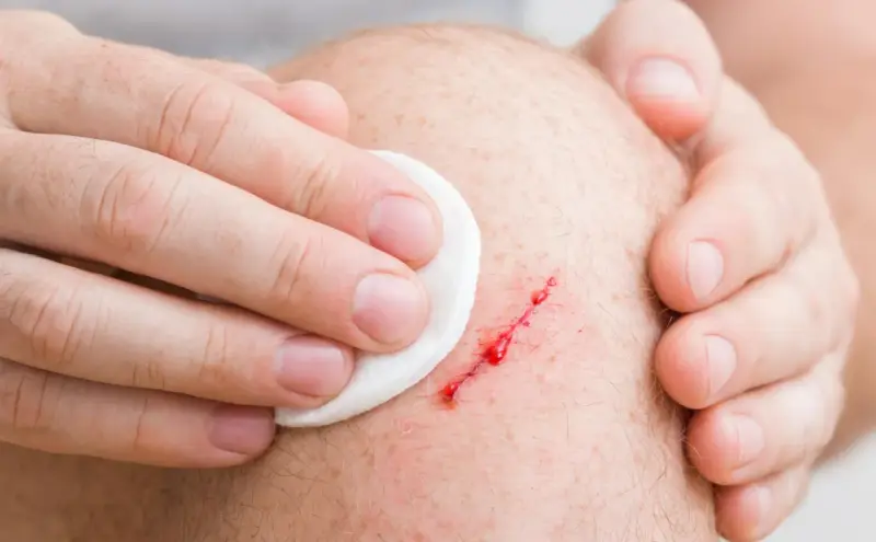 Mano che pulisce una ferita sanguinante sul ginocchio, segno di pelle che si lacera facilmente.