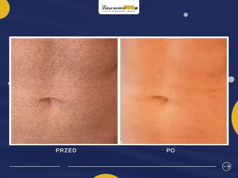 Przed i po depilacji laserowej brzucha. Widoczne spektakularne efekty redukcji owłosienia.