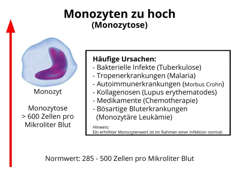 Erhöhte Monozyten (Monozytose) können auf Infektionen, Autoimmunerkrankungen oder Leukämie hinweisen. Der Normwert liegt bei 285-500 Zellen/µl.