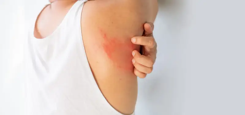 Un'eruzione cutanea rossa e pruriginosa sulla spalla, che fa sudare dietro la nuca per il disagio.