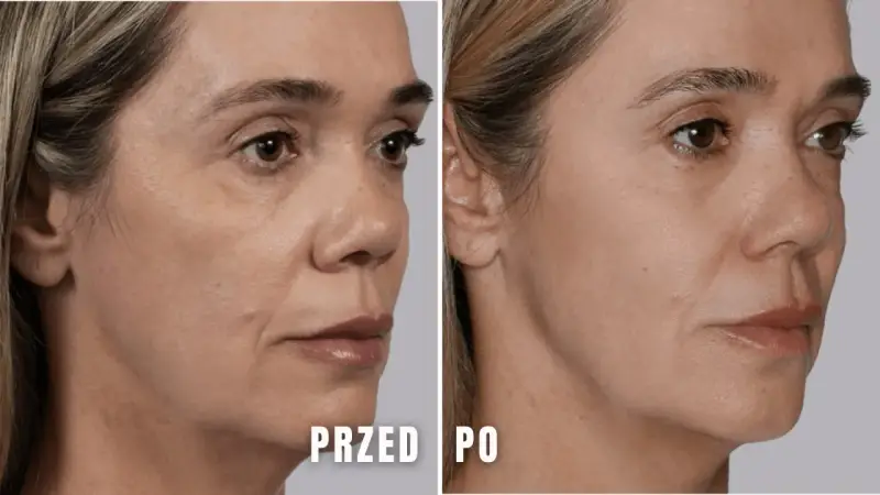 Przed i po zabiegu z użyciem kwasu polimlekowego. Skóra twarzy wygładzona, zmarszczki zredukowane, a owal twarzy poprawiony.