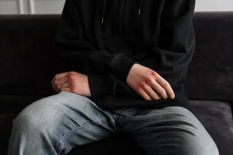 Otarte dłonie z zaczerwienieniami, siedząca osoba w bluzie i jeansach. Może to być symbol stresu przed niebieska karta przesłuchanie.
