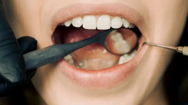 Dentysta bada ząb z plombą. Czy wiesz, plomba co to jest? To wypełnienie ubytku w zębie.
