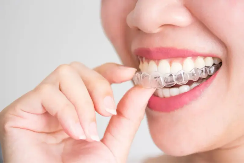 Kobieta z różowymi ustami zakłada przezroczysty aparat Invisalign na zęby.