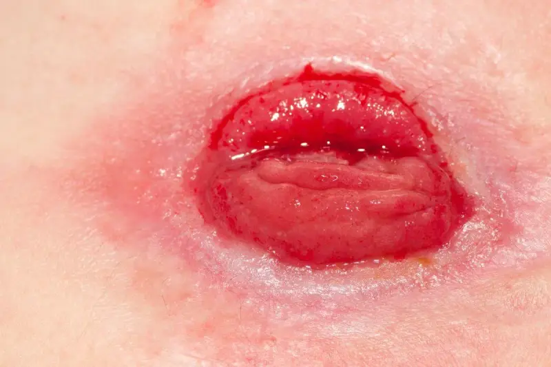 Zbliżenie na ileostomię, widoczny fragment jelita i zaczerwieniona skóra.
