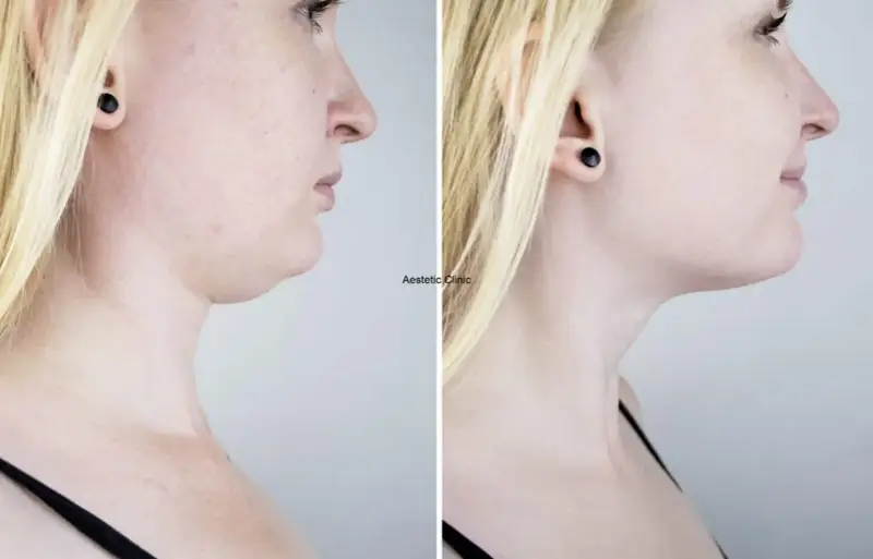 Przed i po zabiegu: widoczna redukcja podwójnego podbródka dzięki lipolizie. Efekty lipolizy podbródka są spektakularne.