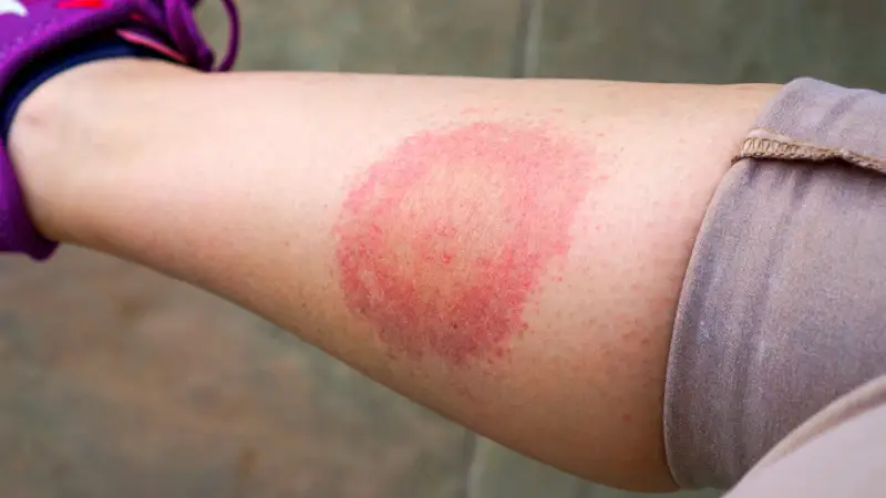Borrelien Symptome beim Menschen: Warnzeichen, die Sie nicht ignorieren sollten