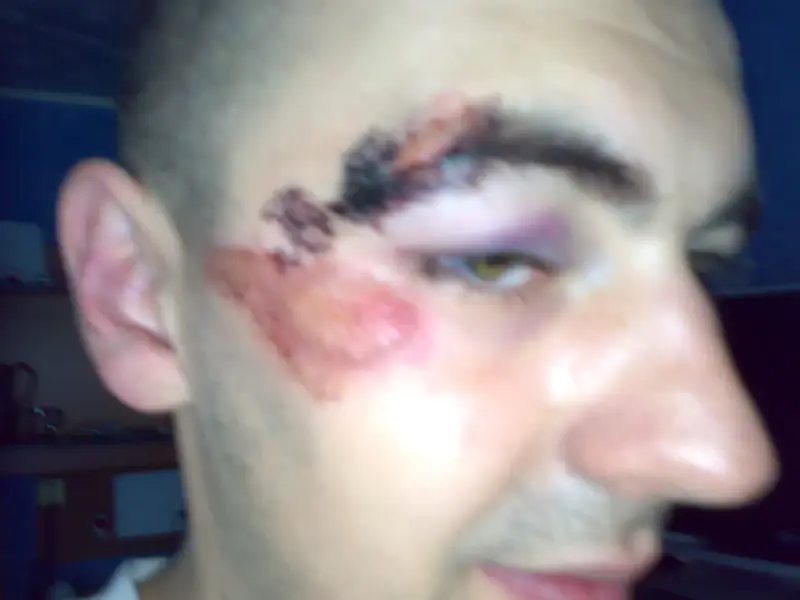 Rozcięty łuk brwiowy z siniakiem i otarciem na policzku.