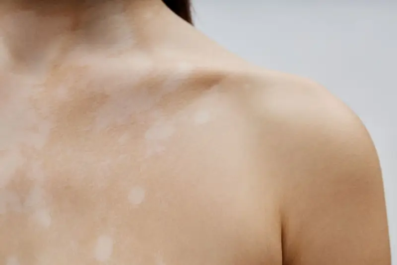 Piel con manchas claras, como si fueran **hongos en la espalda**, cubriendo el cuello y hombro.