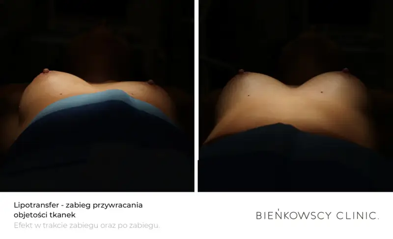 Lipotransfer biustu: porównanie efektów przed i po zabiegu. Widoczne piersi z zaznaczonymi punktami.