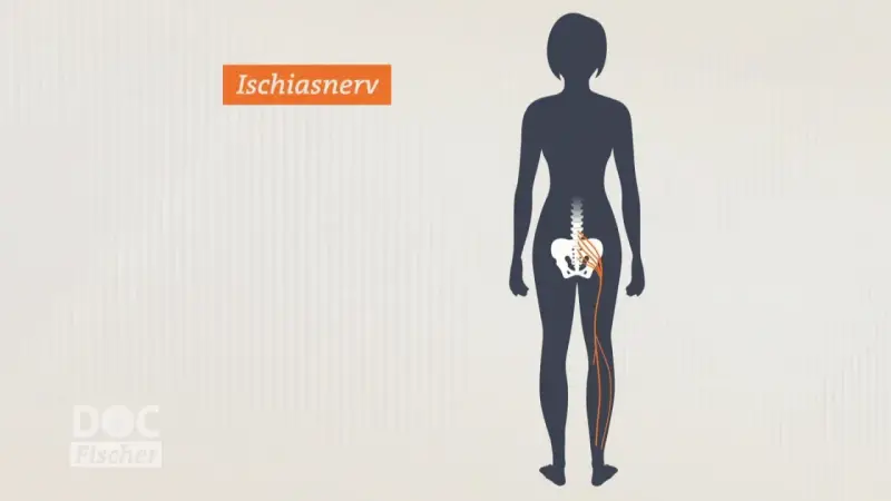 Illustration zeigt den Ischiasnerv, der vom Rückenmark bis ins Bein verläuft. Reizung kann zu Ischias Schmerz führen.