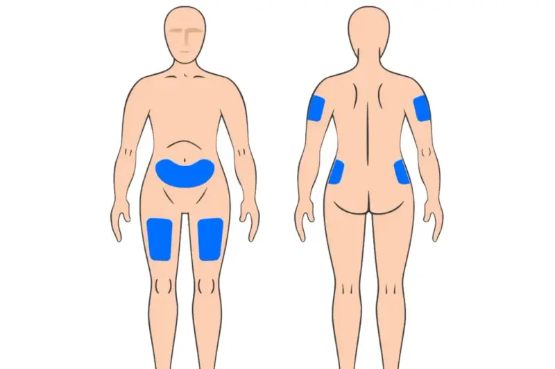Körperstellen für Injektionen: Bauch, Oberschenkel, Oberarme und Gesäß. So kann man weit spritzen.