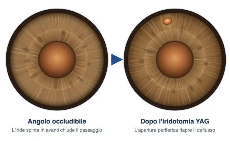 Iridotomia YAG: prima occlusione dell'angolo, dopo apertura per riaprire il deflusso. Valutare i rischi.