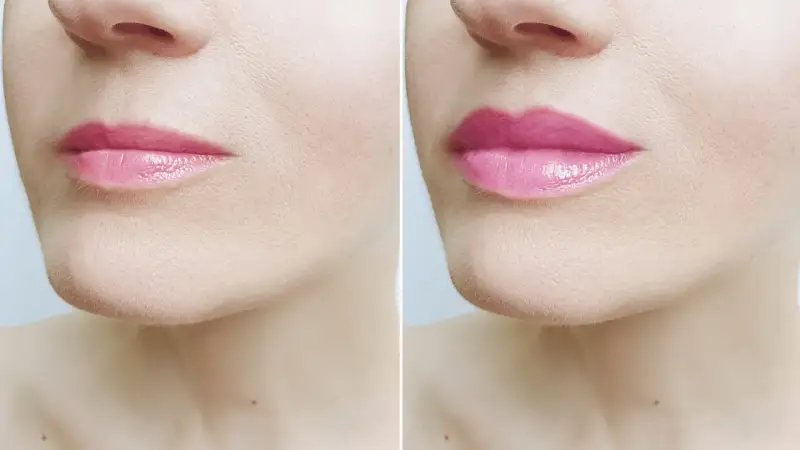 Przed i po zabiegu botox lip flip. Usta po zabiegu są pełniejsze i bardziej wyraziste.