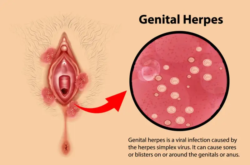 Illustrazione di herpes vaginale con lesioni e ingrandimento del virus.