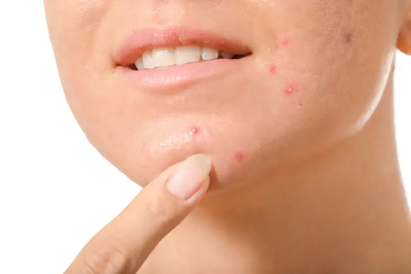 Primo piano del viso di una persona con evidenti segni di acne cistica sul mento e sulla guancia, con un dito che indica una lesione.
