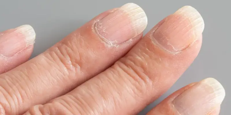 Gros plan sur des doigts montrant des ongles striés verticalement. La signification de ces ongles striés peut varier.