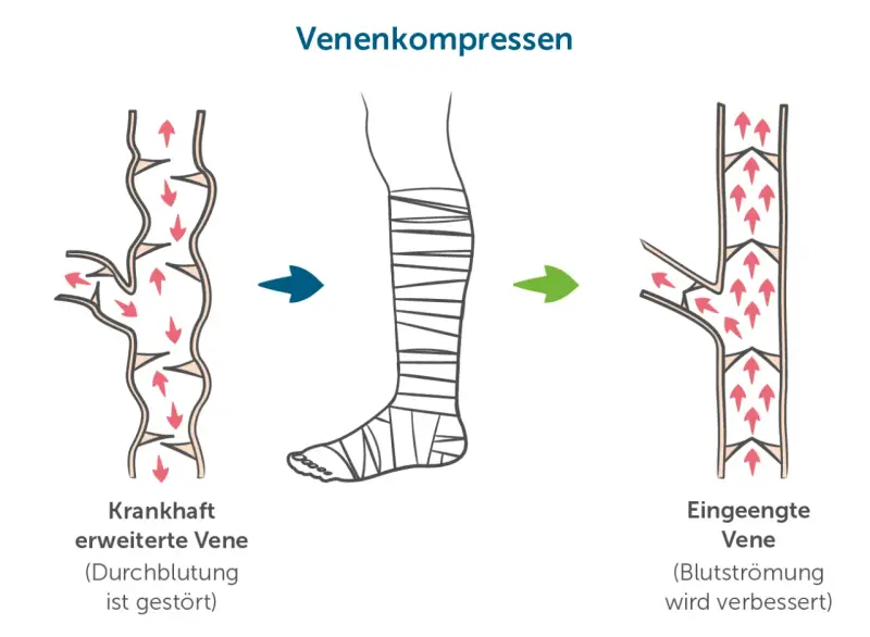 Venenkompression: Von erweiterter Vene mit gestörter Durchblutung zur eingeengten Vene mit verbesserter Blutströmung. Eine Alternative zur Thrombosespritze.