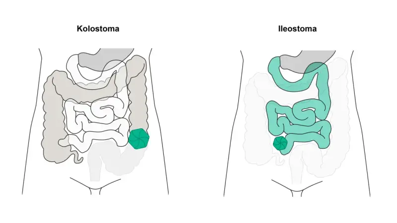 Vergleich von Kolostoma und Ileostoma: zwei stoma arten, die den Darm betreffen.