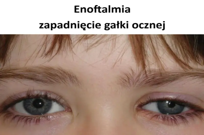 Widoczne zapadnięte oczodoły, objaw enoftalmii.