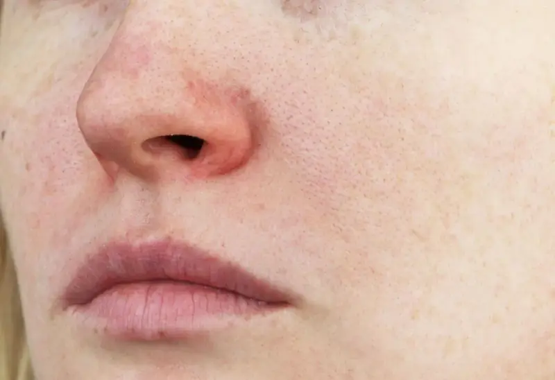 Rote Gesichtshaut Ursachen: Verborgene Gründe und wirksame Lösungen
