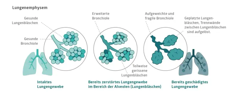 Veranschaulicht die Zerstörung von Lungenbläschen bei COPD, auch ohne Rauchen. Zeigt gesunde, erweiterte und geplatzte Lungenbläschen.