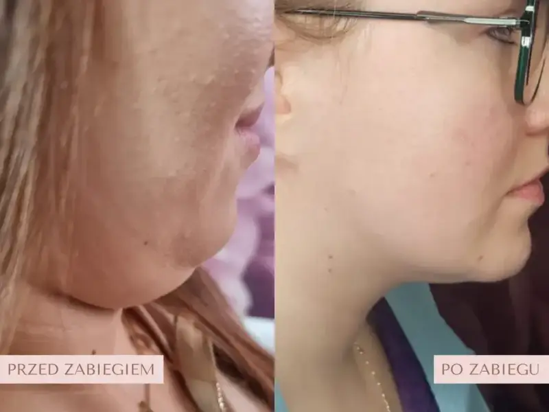 Przed i po zabiegu lipolizy podbródka. Widoczna redukcja tkanki tłuszczowej, wyraźniejsza linia żuchwy.