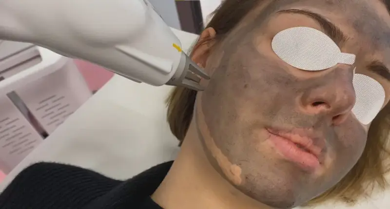 Zabieg laserowy na twarz z maską węglową. Skóra przygotowana do peelingu węglowego.