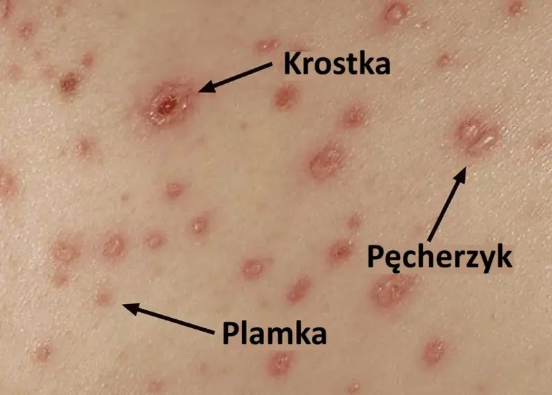 Skóra z licznymi zmianami: plamkami, krostkami i pęcherzykami, typowymi objawami ospy wietrznej.