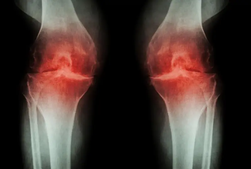 RTG kolan z zaznaczoną osteofitami i zwężeniem szpary stawowej, sugerujące chorobę zwyrodnieniową. Może być wskazana osteotomia podkolanowa.